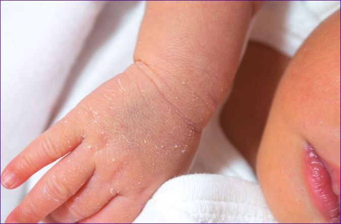 Suchá pokožka u dieťaťa: 20 príčin a 10 nápravných opatrení
