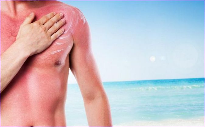 Čo robiť, keď sa spálite na slnku: prvá pomoc, prehľad 6 produktov na starostlivosť a ochranu pokožky
