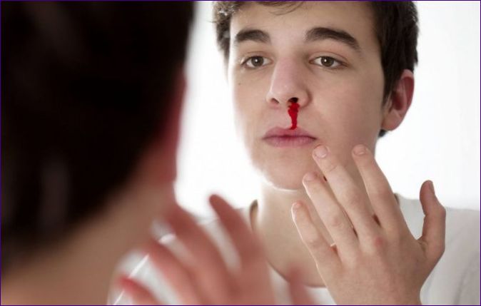 Krvácanie z nosa