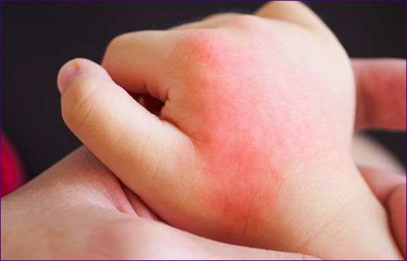 Suchá pokožka na detskom tele, rukách a nohách: príčiny, prehľad 10 produktov starostlivosti o pokožku